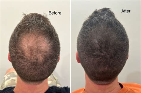 Scalp Micropigmentation in Miami, Florida